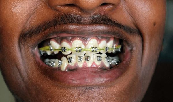 How much does Dental Braces cost in South Africa? Find out here