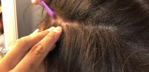 7 effective home remedies to get rid of lice | Fakaza News